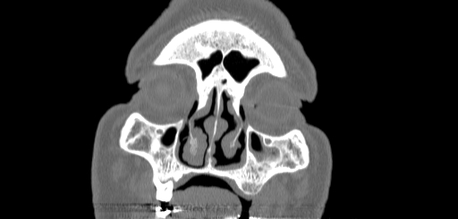 Chronic sphenoidal sinusitis (Radiopaedia 62030-70122 Coronal bone window 24).jpg