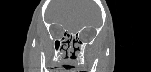 Chronic sphenoidal sinusitis (Radiopaedia 62030-70122 Coronal bone window 78).jpg