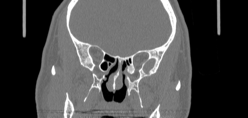 File:Chronic sphenoidal sinusitis (Radiopaedia 62030-70122 Coronal bone window 95).jpg