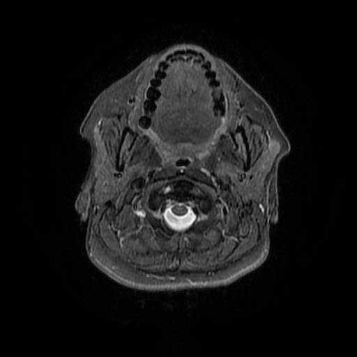 File:Chronic submandibular sialadenitis (Radiopaedia 61852-69885 Axial STIR 9).jpg