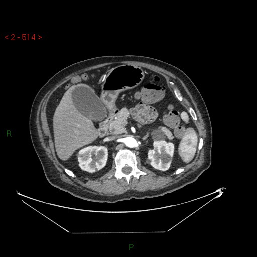 Circumaortic left renal vein and doubled left renal arteries (Radiopaedia 52268-58158 A 50).jpg