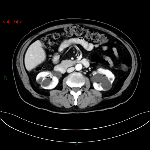 File:Circumaortic left renal vein and doubled left renal arteries (Radiopaedia 52268-58158 B 34).jpg