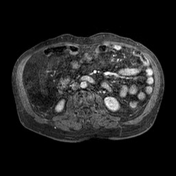 File:Cirrhosis and hepatocellular carcinoma in the setting of hemochromatosis (Radiopaedia 75394-86594 Axial T1 C+ fat sat 179).jpg