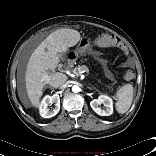 File:Cirrhosis and hepatocellular carcinoma in the setting of hemochromatosis (Radiopaedia 75394-86595 A 35).jpg