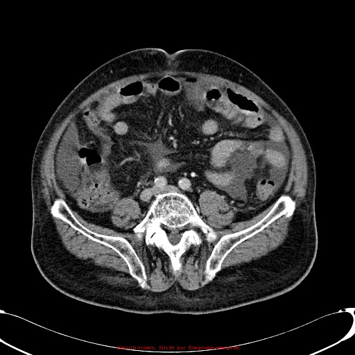 Cirrhosis and hepatocellular carcinoma in the setting of hemochromatosis (Radiopaedia 75394-86595 B 59).jpg
