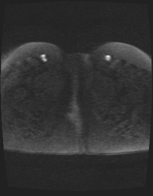 Class II Mullerian duct anomaly- unicornuate uterus with rudimentary horn and non-communicating cavity (Radiopaedia 39441-41755 Axial DWI 63).jpg