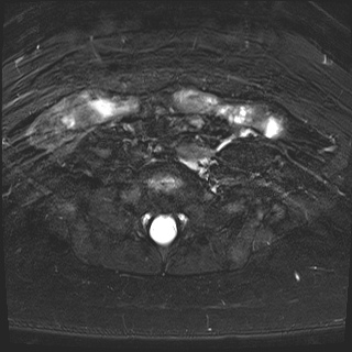 File:Class II Mullerian duct anomaly- unicornuate uterus with rudimentary horn and non-communicating cavity (Radiopaedia 39441-41755 Axial T2 fat sat 3).jpg