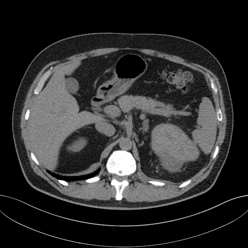 File:Clear cell renal cell carcinoma (Radiopaedia 61449-69393 Axial non-contrast 17).jpg