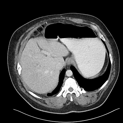 File:Closed loop obstruction - internal hernia into nephrectomy bed (Radiopaedia 59867-67320 A 27).jpg