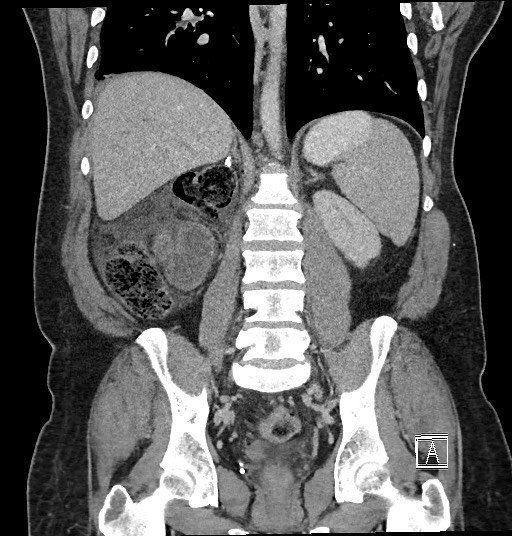 File:Closed loop obstruction - internal hernia into nephrectomy bed (Radiopaedia 59867-67320 B 94).jpg
