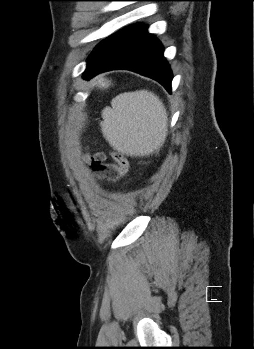 Closed loop obstruction - internal hernia into nephrectomy bed (Radiopaedia 59867-67320 C 1).jpg