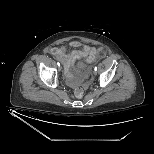 File:Closed loop obstruction due to adhesive band, resulting in small bowel ischemia and resection (Radiopaedia 83835-99023 B 132).jpg