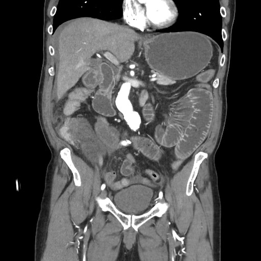 File:Closed loop obstruction due to adhesive band, resulting in small bowel ischemia and resection (Radiopaedia 83835-99023 C 58).jpg