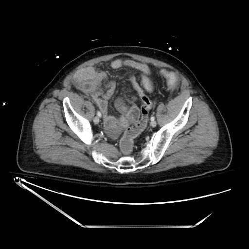 File:Closed loop obstruction due to adhesive band, resulting in small bowel ischemia and resection (Radiopaedia 83835-99023 D 126).jpg