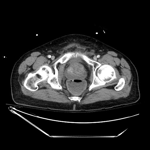 File:Closed loop obstruction due to adhesive band, resulting in small bowel ischemia and resection (Radiopaedia 83835-99023 D 150).jpg