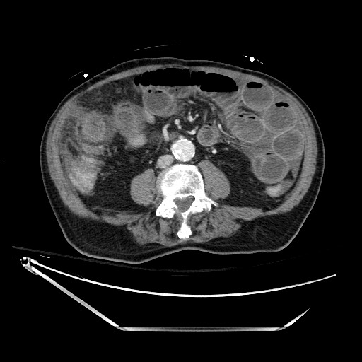 File:Closed loop obstruction due to adhesive band, resulting in small bowel ischemia and resection (Radiopaedia 83835-99023 D 86).jpg