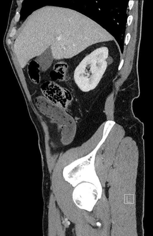 Closed loop small bowel obstruction - internal hernia (Radiopaedia 57806-64778 C 85).jpg