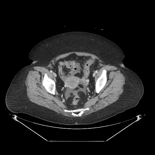 Closed loop small bowel obstruction - internal hernia (Radiopaedia 65402-74450 A 115).jpg