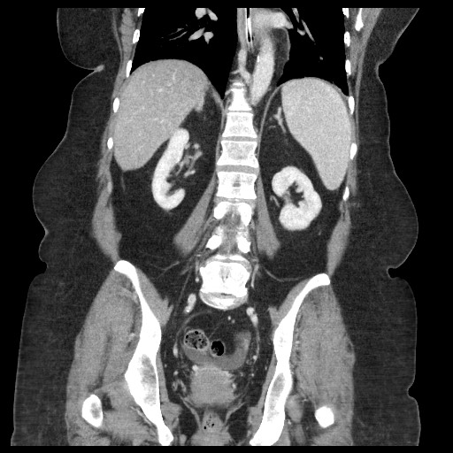 Closed loop small bowel obstruction - internal hernia (Radiopaedia 65402-74450 B 73).jpg
