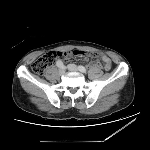 Closed loop small bowel obstruction - omental adhesion causing "internal hernia" (Radiopaedia 85129-100682 A 118).jpg