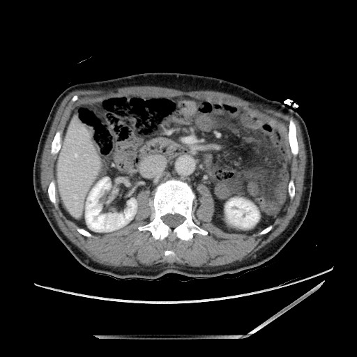 Closed loop small bowel obstruction - omental adhesion causing "internal hernia" (Radiopaedia 85129-100682 A 67).jpg