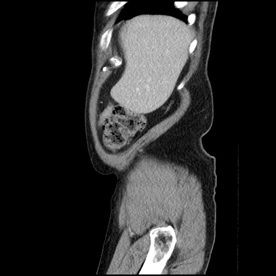 Closed loop small bowel obstruction due to adhesive band - U-shaped loop (Radiopaedia 83829-99012 C 62).jpg