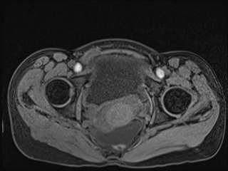 Closed loop small bowel obstruction in pregnancy (MRI) (Radiopaedia 87637-104031 F 65).jpg