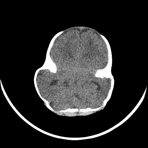 File:Cloverleaf shaped skull in the absence of craniosynostosis (Radiopaedia 21296-21216 Axial non-contrast 6).jpg