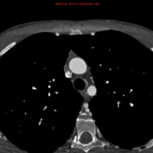 File:Coarctation of the aorta (Radiopaedia 12461-12697 A 87).jpg