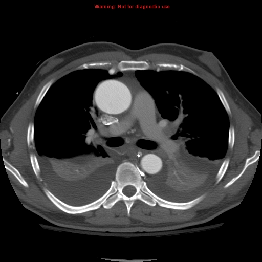 File:Coarctation of the aorta (Radiopaedia 8681-9490 B 30).jpg