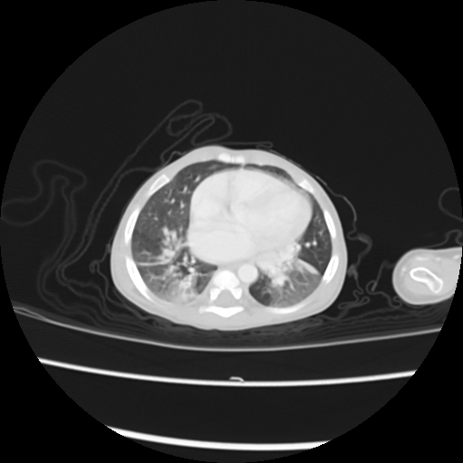 Coarctation of the aorta and patent ductus arteriosus (Radiopaedia 68033-77499 Axial lung window 36).jpg