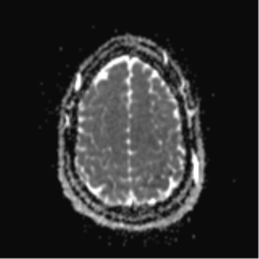 File:Colloid cyst (Radiopaedia 44510-48181 Axial ADC 24).png