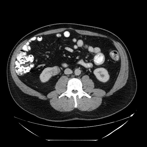 Colocolic intussusception due to lipoma (Radiopaedia 73712-84508 A 61).jpg