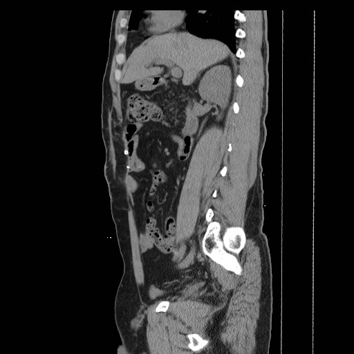File:Colocutaneous fistula in Crohn's disease (Radiopaedia 29586-30093 C 14).jpg