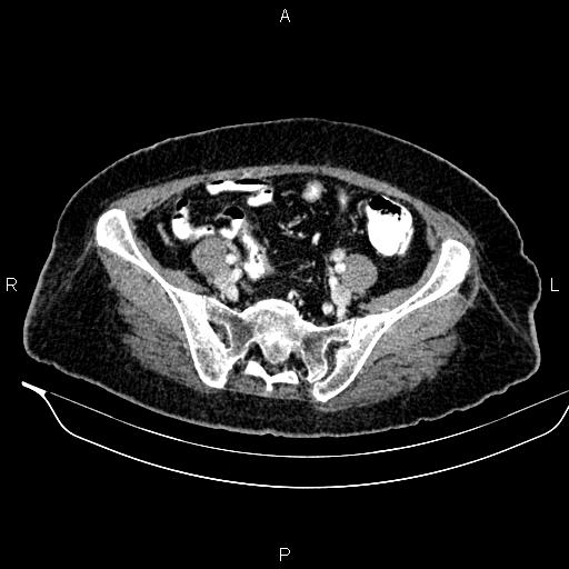 Colon adenocarcinoma (Radiopaedia 91240-108842 A 72).jpg
