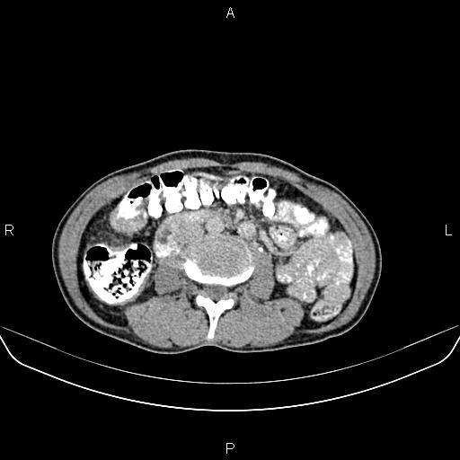 File:Colon adenocarcinoma - hepatic flexure (Radiopaedia 85635-101395 Axial C+ delayed 46).jpg