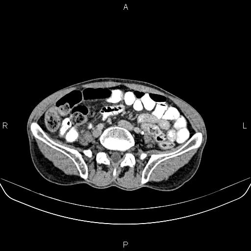 File:Colon adenocarcinoma - hepatic flexure (Radiopaedia 85635-101395 Axial C+ delayed 63).jpg