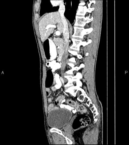 Colon adenocarcinoma - hepatic flexure (Radiopaedia 85635-101395 D 38).jpg