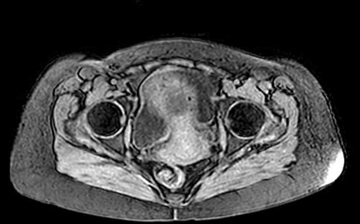 File:Colon adenocarcinoma with Krukenberg tumors, advanced pregnancy (Radiopaedia 67279-76645 A 12).jpg