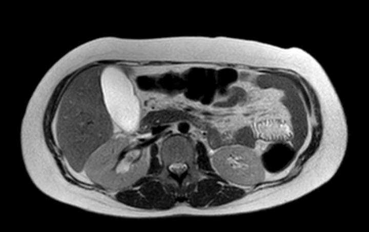 File:Colon adenocarcinoma with Krukenberg tumors, advanced pregnancy (Radiopaedia 67279-76645 Axial T2 52).jpg