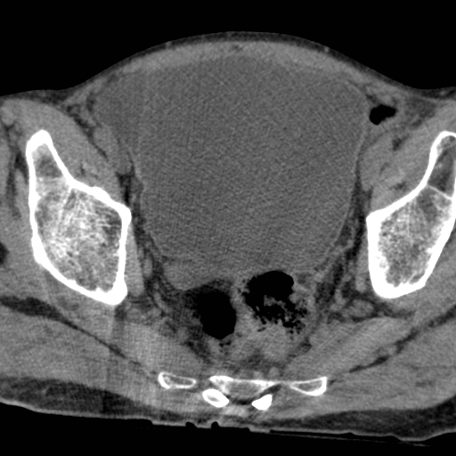 Colon cancer with calcified liver metastasis (Radiopaedia 74423-85309 Axial non-contrast 102).jpg