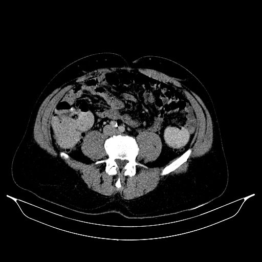 Colonic diverticulosis (Radiopaedia 72222-82744 A 59).jpg
