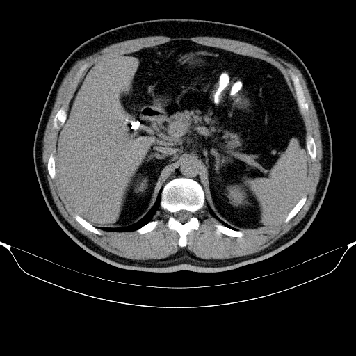 Colonic lipoma with colo-colic intussusception (Radiopaedia 58944-66200 Axial C+ rectal 13).jpg