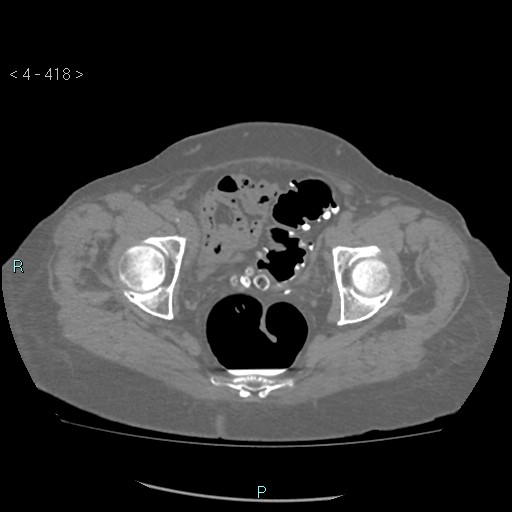 Colonic lipomas (Radiopaedia 49137-54244 Axial bone window 186).jpg
