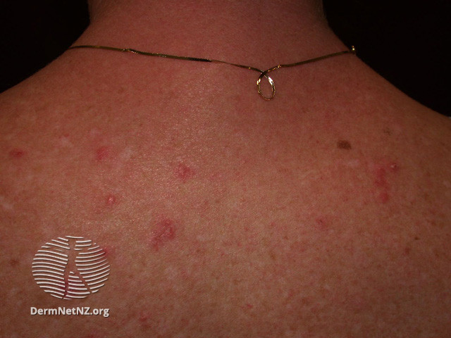 Cutaneous lupus erythematosus (DermNet NZ immune-lupus-erythematosus-2541).jpg