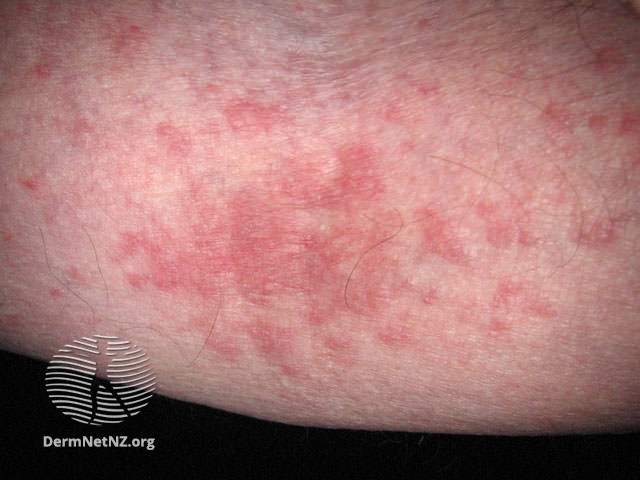 File:Elbow crease (DermNet NZ dermatitis-atopic41).jpg