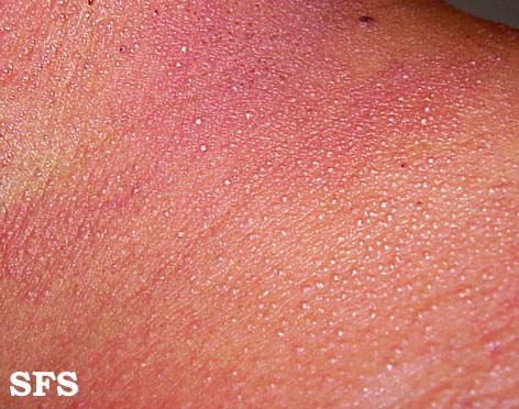 File:Miliaria (Dermatology Atlas 3).jpg