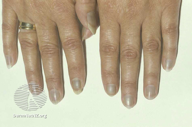 File:Minocycline induced blue nails (DermNet NZ blue-nails-0).jpg