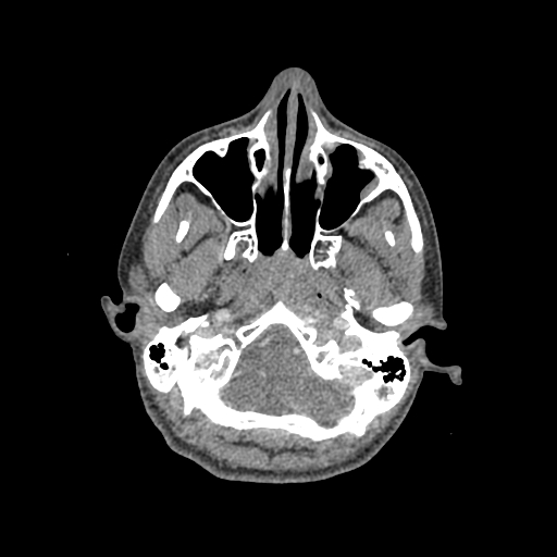 Nasal pyogenic granuloma (lobular capillary hemangioma) (Radiopaedia 85536-101244 C 60).jpg