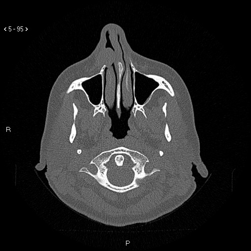 Nasolabial cyst (Radiopaedia 75125-86194 Axial bone window 56).jpg